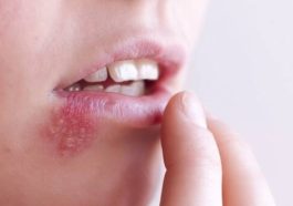 ویروس تبخال می‌تواند باعث افزایش ریسک ابتلا به زوال عقل شود